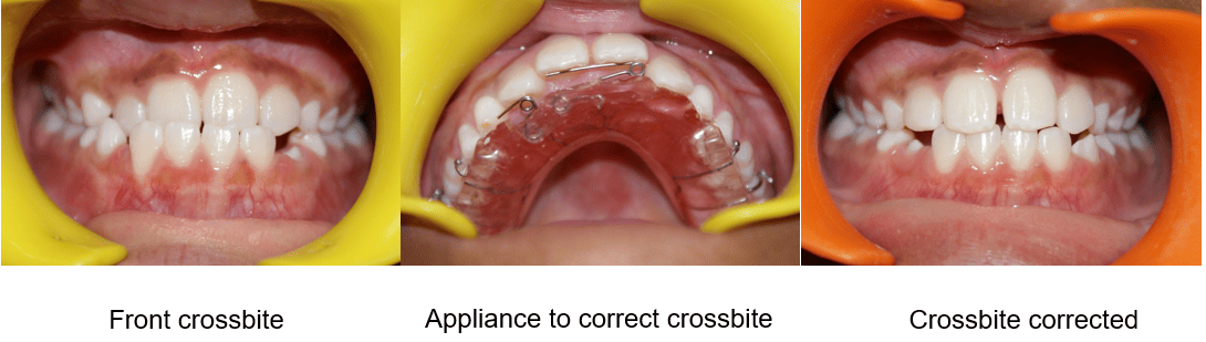 Orthodontic Treatment Gallery Image 2