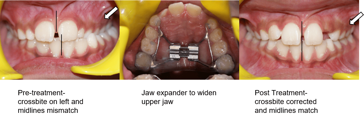 Orthodontic Treatment Gallery Image 2