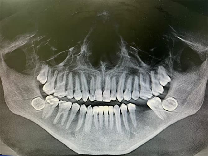 Impacted Teeth and Teeth Stuck in Jaw Bone - Orthodontic Treatment
