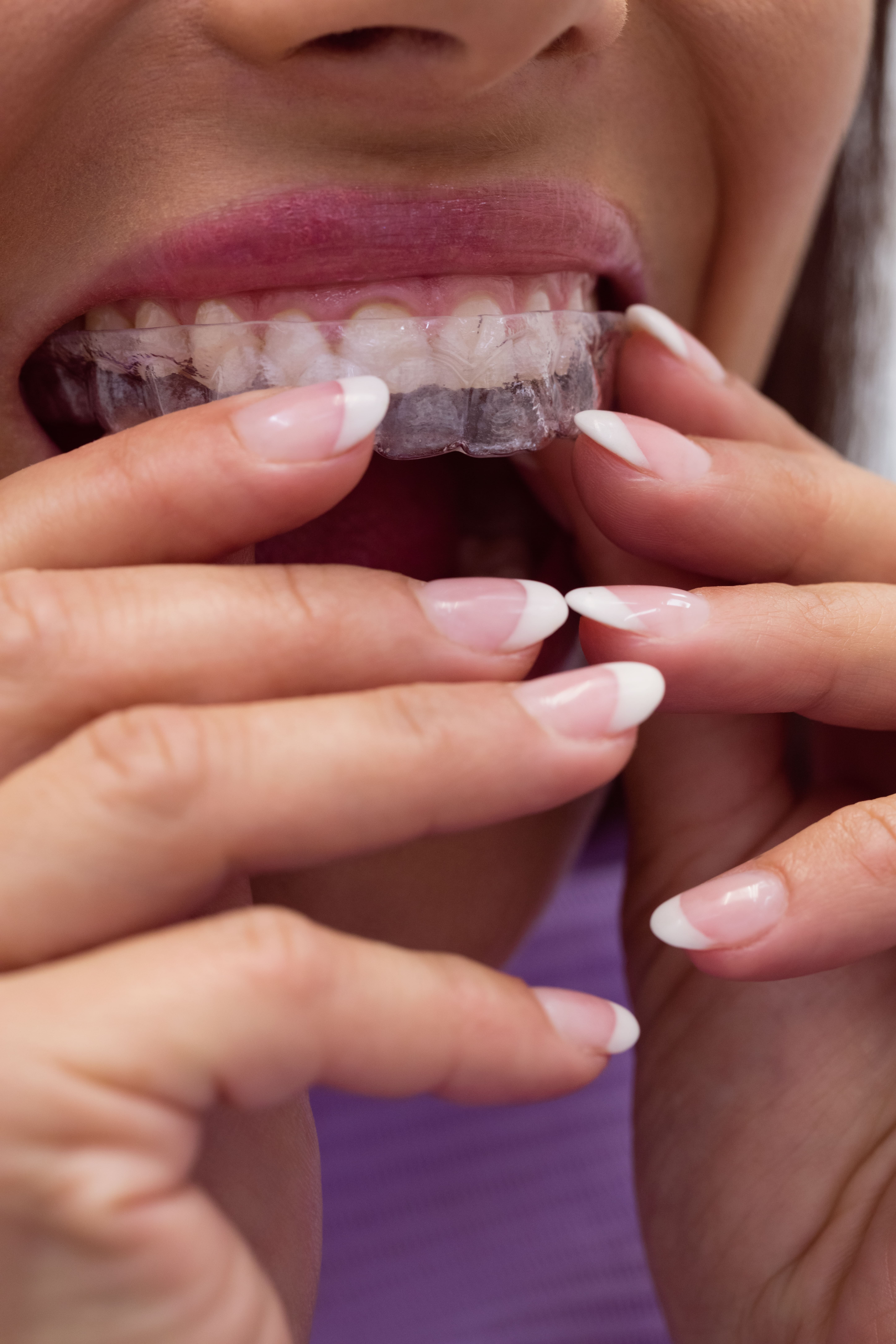 Invisalign clear aligners for straight teeth