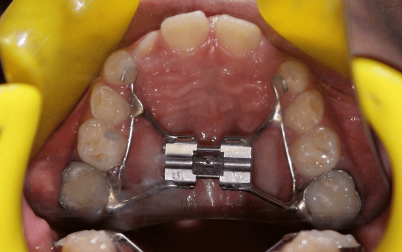 Orthodontic Treatment Gallery Image 2