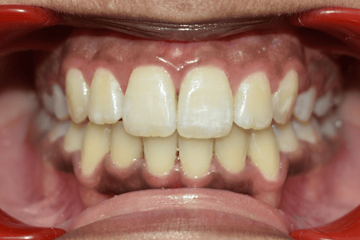 After Orthodontic Treatment - Straightened Smile by Smiles in Motion