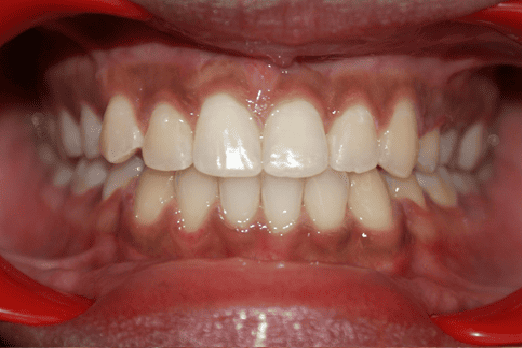 After Orthodontic Treatment - Perfect Bite and Aligned Smile