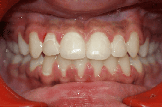 After Orthodontic Treatment - Perfect Bite and Aligned Smile