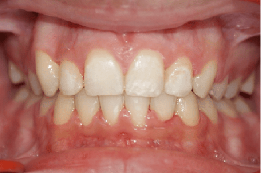 After Orthodontic Treatment - Perfect Bite and Aligned Smile