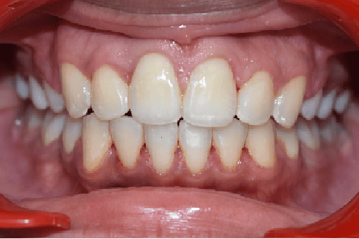 After Orthodontic Treatment - Perfect Bite and Aligned Smile