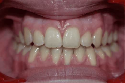 After Orthodontic Treatment - Perfect Bite and Aligned Smile