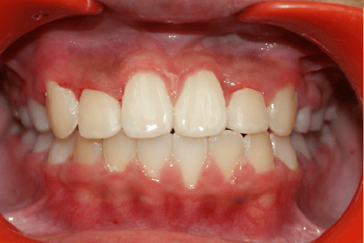 After Orthodontic Treatment - Perfect Bite and Aligned Smile