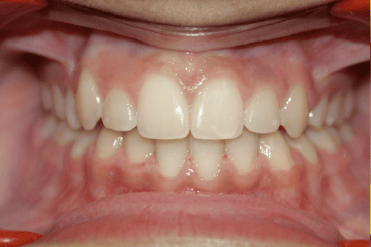 After Orthodontic Treatment - Perfect Bite and Aligned Smile
