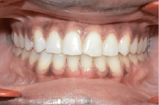After Orthodontic Treatment - Perfect Bite and Aligned Smile