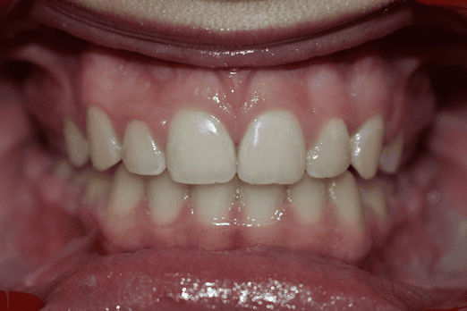 After Orthodontic Treatment - Perfect Bite and Aligned Smile
