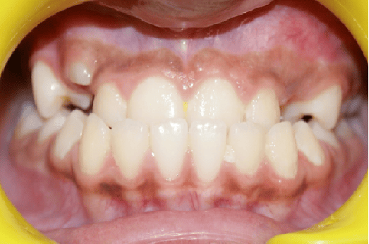 Before Orthodontic Treatment - Overbite Correction at Smiles in Motion