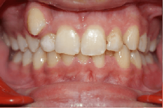 Before Orthodontic Treatment - Overbite Correction at Smiles in Motion
