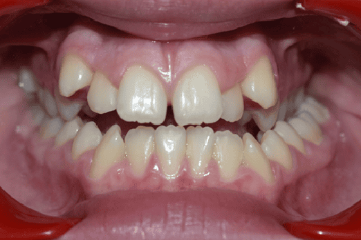 Before Orthodontic Treatment - Overbite Correction at Smiles in Motion