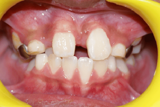 Before Orthodontic Treatment - Overbite Correction at Smiles in Motion