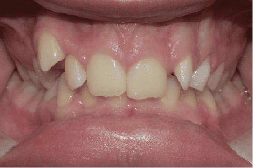 Before Orthodontic Treatment - Overbite Correction at Smiles in Motion