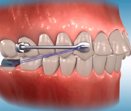 Carriere Distalizer Appliance for Class II Overbite Correction