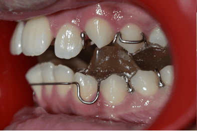 After Orthodontic Treatment - Straightened Smile by Smiles in Motion