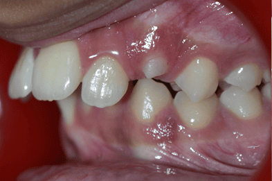 Before Orthodontic Treatment - Crooked Teeth Correction by Smiles in Motion