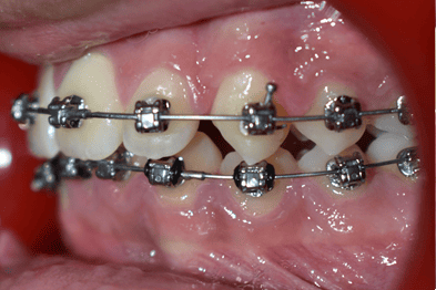 Before Orthodontic Treatment - Crooked Teeth Correction by Smiles in Motion