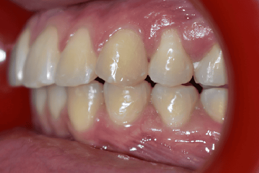 After Orthodontic Treatment - Straightened Smile by Smiles in Motion