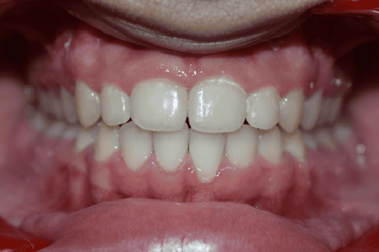 After Orthodontic Treatment - Straightened Smile by Smiles in Motion