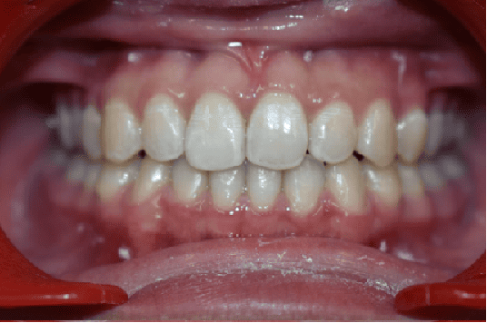 After Orthodontic Treatment - Straightened Smile by Smiles in Motion