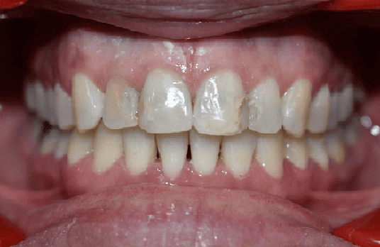 After Orthodontic Treatment - Straightened Smile by Smiles in Motion
