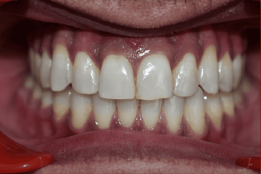 After Orthodontic Treatment - Straightened Smile by Smiles in Motion