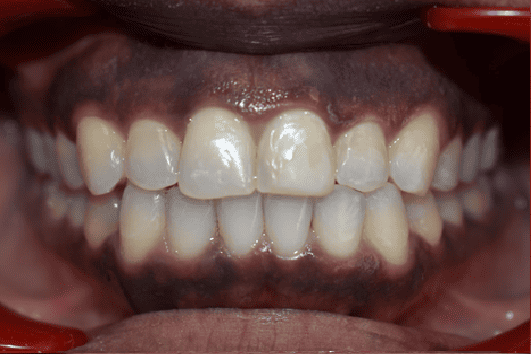 After Orthodontic Treatment - Straightened Smile by Smiles in Motion