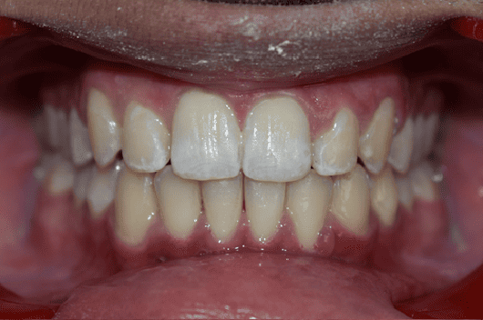 After Orthodontic Treatment - Straightened Smile by Smiles in Motion