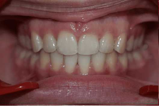 After Orthodontic Treatment - Straightened Smile by Smiles in Motion
