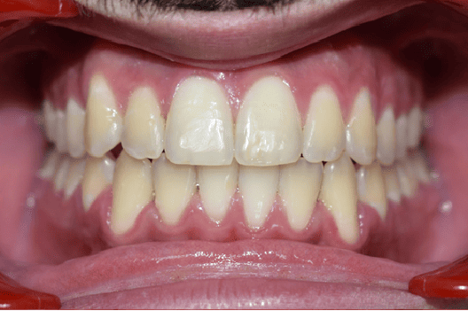 After Orthodontic Treatment - Straightened Smile by Smiles in Motion