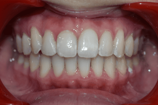 After Orthodontic Treatment - Straightened Smile by Smiles in Motion