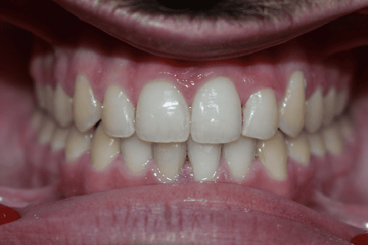 After Orthodontic Treatment - Straightened Smile by Smiles in Motion