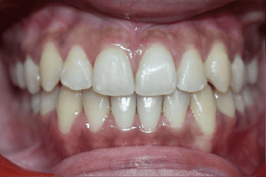 After Orthodontic Treatment - Straightened Smile by Smiles in Motion