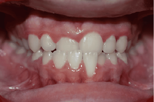 Before Orthodontic Treatment - Crooked Teeth Correction by Smiles in Motion