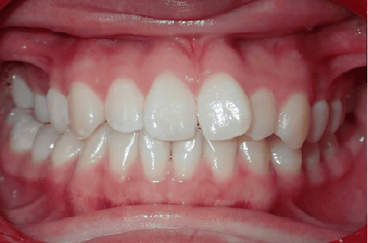 Before Orthodontic Treatment - Crooked Teeth Correction by Smiles in Motion