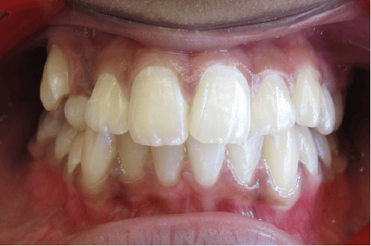 Before Orthodontic Treatment - Crooked Teeth Correction by Smiles in Motion