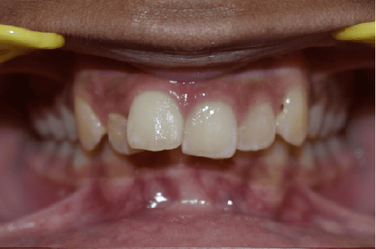 Before Orthodontic Treatment - Crooked Teeth Correction by Smiles in Motion