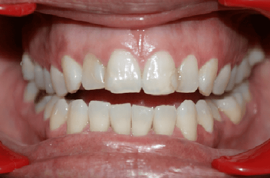 Before Orthodontic Treatment - Crooked Teeth Correction by Smiles in Motion