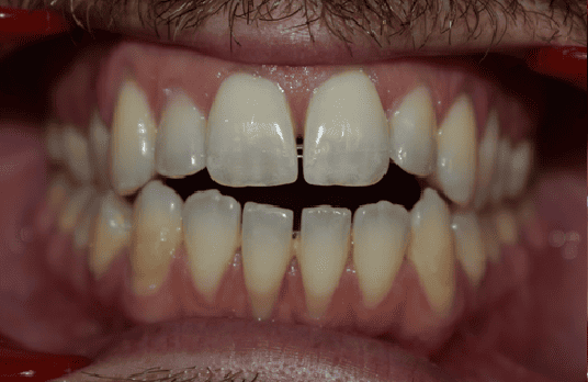 Before Orthodontic Treatment - Crooked Teeth Correction by Smiles in Motion