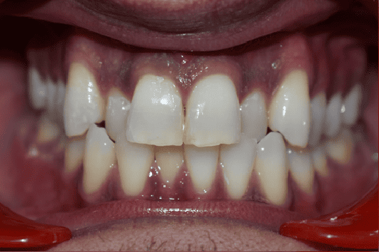 Before Orthodontic Treatment - Crooked Teeth Correction by Smiles in Motion