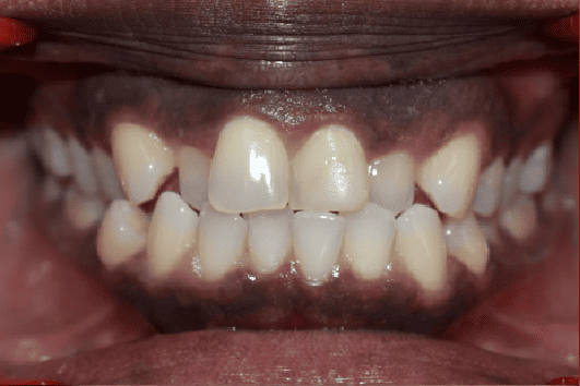 Before Orthodontic Treatment - Crooked Teeth Correction by Smiles in Motion