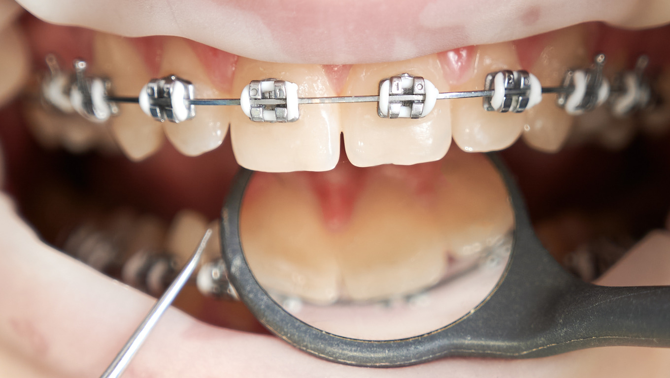 Why Wearing Elastics as Directed Is Essential for Successful Orthodontic Treatment