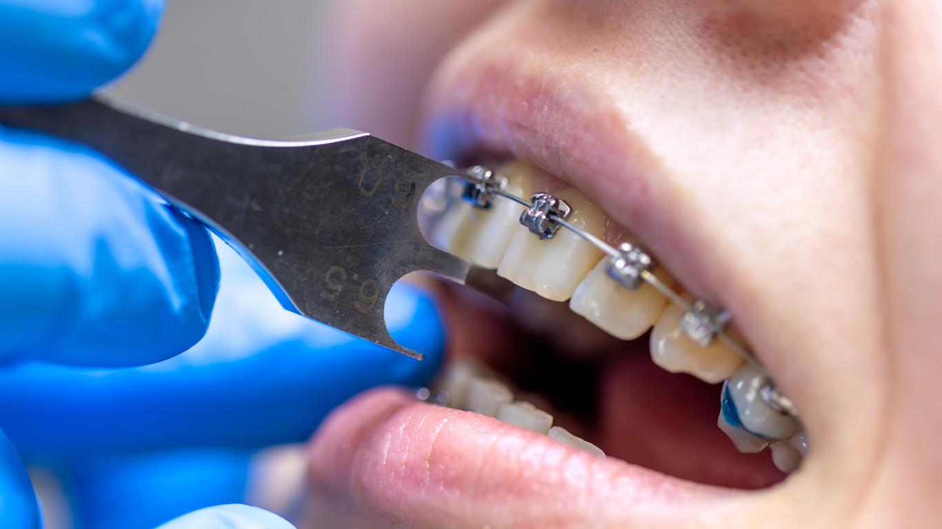 Why Choose Smiles in Motion Orthodontics for Your Invisalign or Braces Treatment